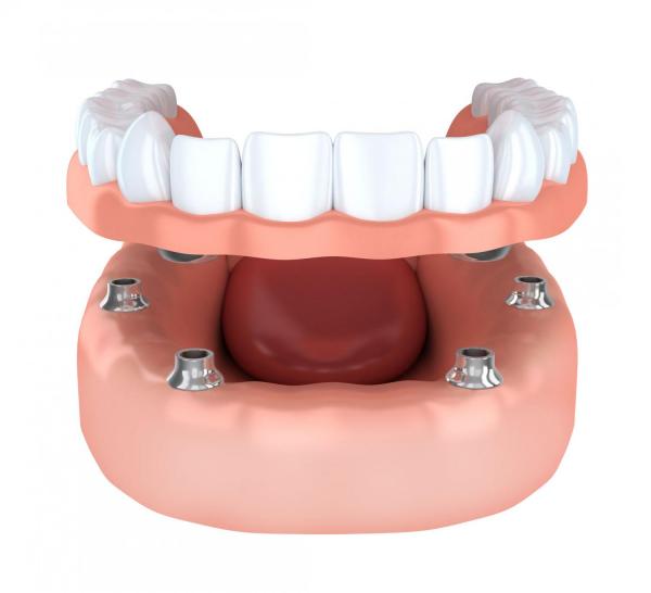 Implant supported overdenture