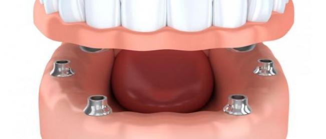 Implant supported overdenture