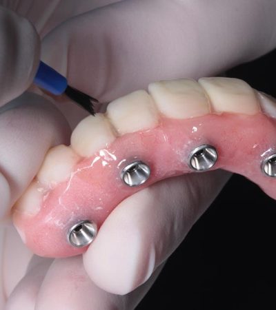 all-on-4-implants-step-by-step-opt