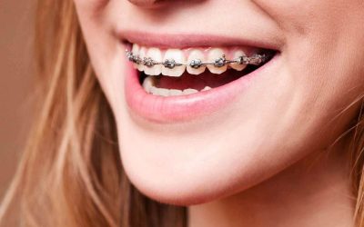 braces-banner-1