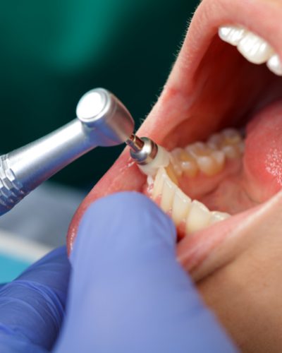 Close up of a professional dental brushing at the clinic